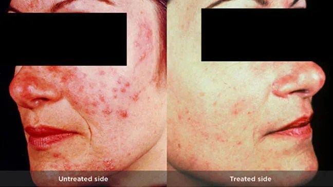 What Is Rosacea And How Is It Treated?